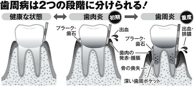 歯周病の２つの段階